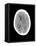 Subdural Haemorrhage, MRI Scan-Du Cane Medical-Framed Stretched Canvas