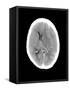 Subdural Haemorrhage, MRI Scan-Du Cane Medical-Framed Stretched Canvas