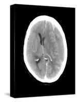 Subdural Haemorrhage, MRI Scan-Du Cane Medical-Stretched Canvas