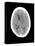 Subdural Haemorrhage, MRI Scan-Du Cane Medical-Stretched Canvas