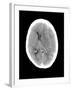 Subdural Haemorrhage, MRI Scan-Du Cane Medical-Framed Photographic Print