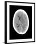 Subdural Haemorrhage, MRI Scan-Du Cane Medical-Framed Photographic Print