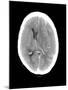 Subdural Haemorrhage, MRI Scan-Du Cane Medical-Mounted Photographic Print