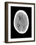 Subdural Haemorrhage, MRI Scan-Du Cane Medical-Framed Photographic Print