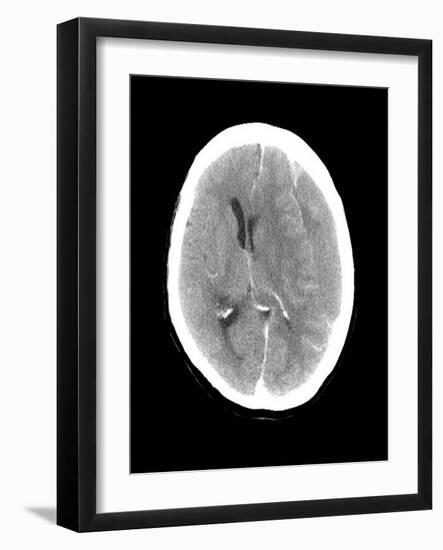 Subdural Haemorrhage, MRI Scan-Du Cane Medical-Framed Photographic Print