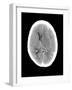 Subdural Haemorrhage, MRI Scan-Du Cane Medical-Framed Photographic Print