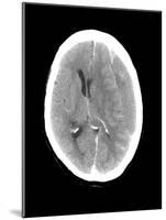 Subdural Haemorrhage, MRI Scan-Du Cane Medical-Mounted Photographic Print