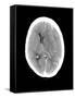 Subdural Haemorrhage, MRI Scan-Du Cane Medical-Framed Stretched Canvas