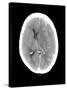 Subdural Haemorrhage, MRI Scan-Du Cane Medical-Stretched Canvas