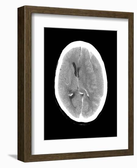 Subdural Haemorrhage, MRI Scan-Du Cane Medical-Framed Photographic Print