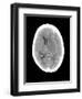 Subdural Haemorrhage, MRI Scan-Du Cane Medical-Framed Photographic Print