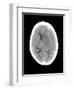 Subdural Haemorrhage, MRI Scan-Du Cane Medical-Framed Photographic Print