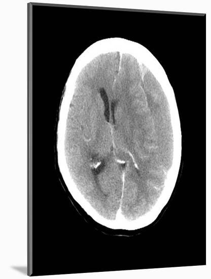 Subdural Haemorrhage, MRI Scan-Du Cane Medical-Mounted Photographic Print