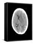 Subdural Haemorrhage, MRI Scan-Du Cane Medical-Framed Stretched Canvas