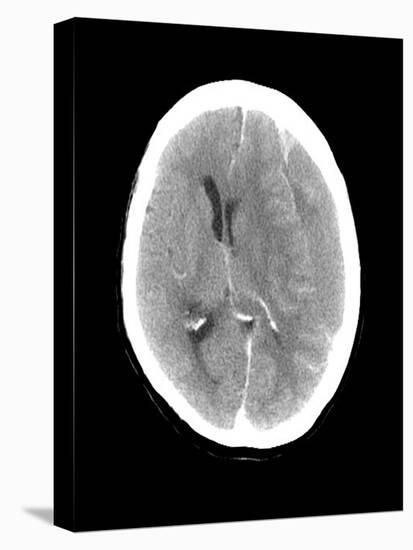 Subdural Haemorrhage, MRI Scan-Du Cane Medical-Stretched Canvas