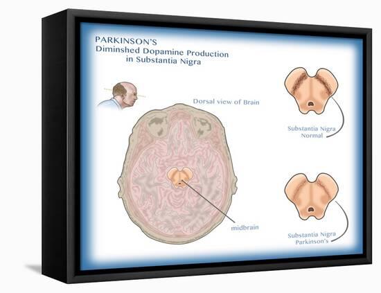 Substantia Nigra & Parkinson's Disease-Monica Schroeder-Framed Stretched Canvas