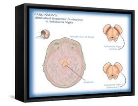 Substantia Nigra & Parkinson's Disease-Monica Schroeder-Framed Stretched Canvas