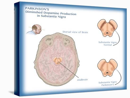 Substantia Nigra & Parkinson's Disease-Monica Schroeder-Stretched Canvas