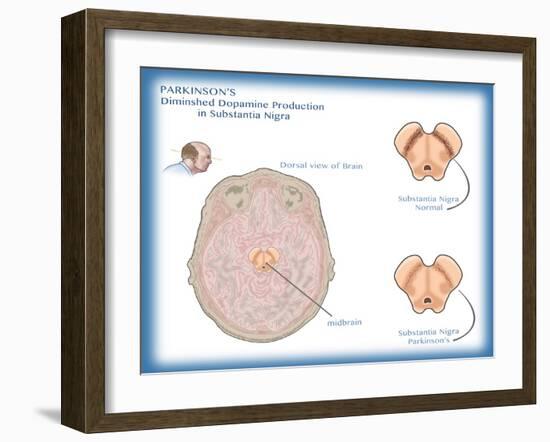 Substantia Nigra & Parkinson's Disease-Monica Schroeder-Framed Giclee Print