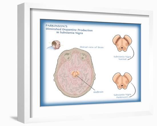 Substantia Nigra & Parkinson's Disease-Monica Schroeder-Framed Giclee Print