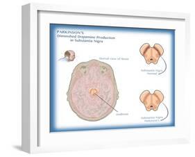 Substantia Nigra & Parkinson's Disease-Monica Schroeder-Framed Giclee Print