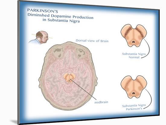 Substantia Nigra & Parkinson's Disease-Monica Schroeder-Mounted Giclee Print