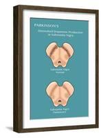 Substantia Nigra & Parkinson's Disease-Monica Schroeder-Framed Giclee Print