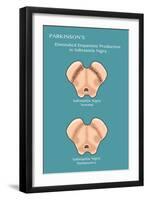 Substantia Nigra & Parkinson's Disease-Monica Schroeder-Framed Giclee Print