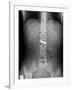 Swallowed Battery, X-ray-Du Cane Medical-Framed Photographic Print