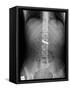 Swallowed Battery, X-ray-Du Cane Medical-Framed Stretched Canvas