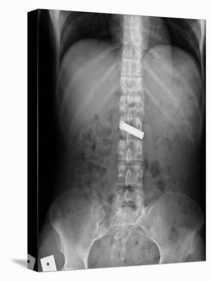 Swallowed Battery, X-ray-Du Cane Medical-Stretched Canvas