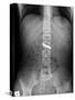 Swallowed Battery, X-ray-Du Cane Medical-Stretched Canvas
