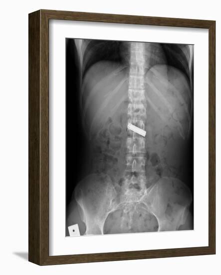 Swallowed Battery, X-ray-Du Cane Medical-Framed Photographic Print