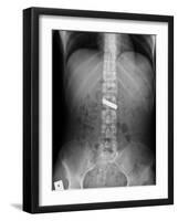 Swallowed Battery, X-ray-Du Cane Medical-Framed Photographic Print