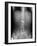 Swallowed Battery, X-ray-Du Cane Medical-Framed Photographic Print