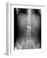 Swallowed Battery, X-ray-Du Cane Medical-Framed Photographic Print