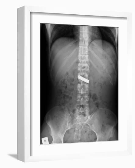 Swallowed Battery, X-ray-Du Cane Medical-Framed Photographic Print