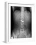 Swallowed Battery, X-ray-Du Cane Medical-Framed Photographic Print