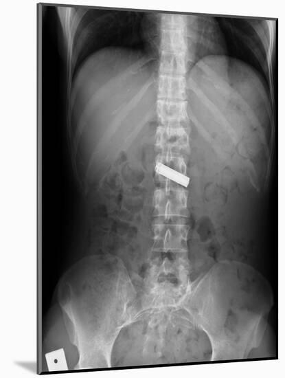 Swallowed Battery, X-ray-Du Cane Medical-Mounted Photographic Print