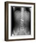 Swallowed Battery, X-ray-Du Cane Medical-Framed Photographic Print