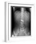 Swallowed Battery, X-ray-Du Cane Medical-Framed Photographic Print