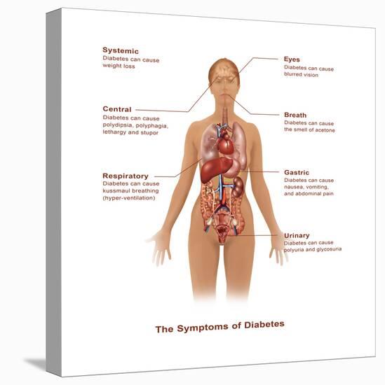 Symptoms of Diabetes-Gwen Shockey-Stretched Canvas