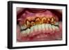 Teeth Showing Plaque-Science Photo Library-Framed Photographic Print