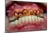 Teeth Showing Plaque-Science Photo Library-Mounted Photographic Print