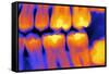 Teeth with Fillings, X-ray-PASIEKA-Framed Stretched Canvas