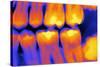 Teeth with Fillings, X-ray-PASIEKA-Stretched Canvas
