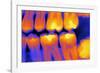 Teeth with Fillings, X-ray-PASIEKA-Framed Photographic Print