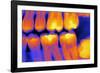 Teeth with Fillings, X-ray-PASIEKA-Framed Photographic Print