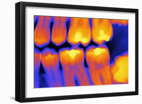 Teeth with Fillings, X-ray-PASIEKA-Framed Photographic Print