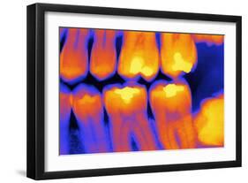 Teeth with Fillings, X-ray-PASIEKA-Framed Photographic Print